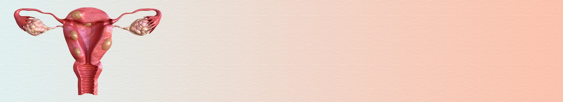 PCOS and its impact on fertility